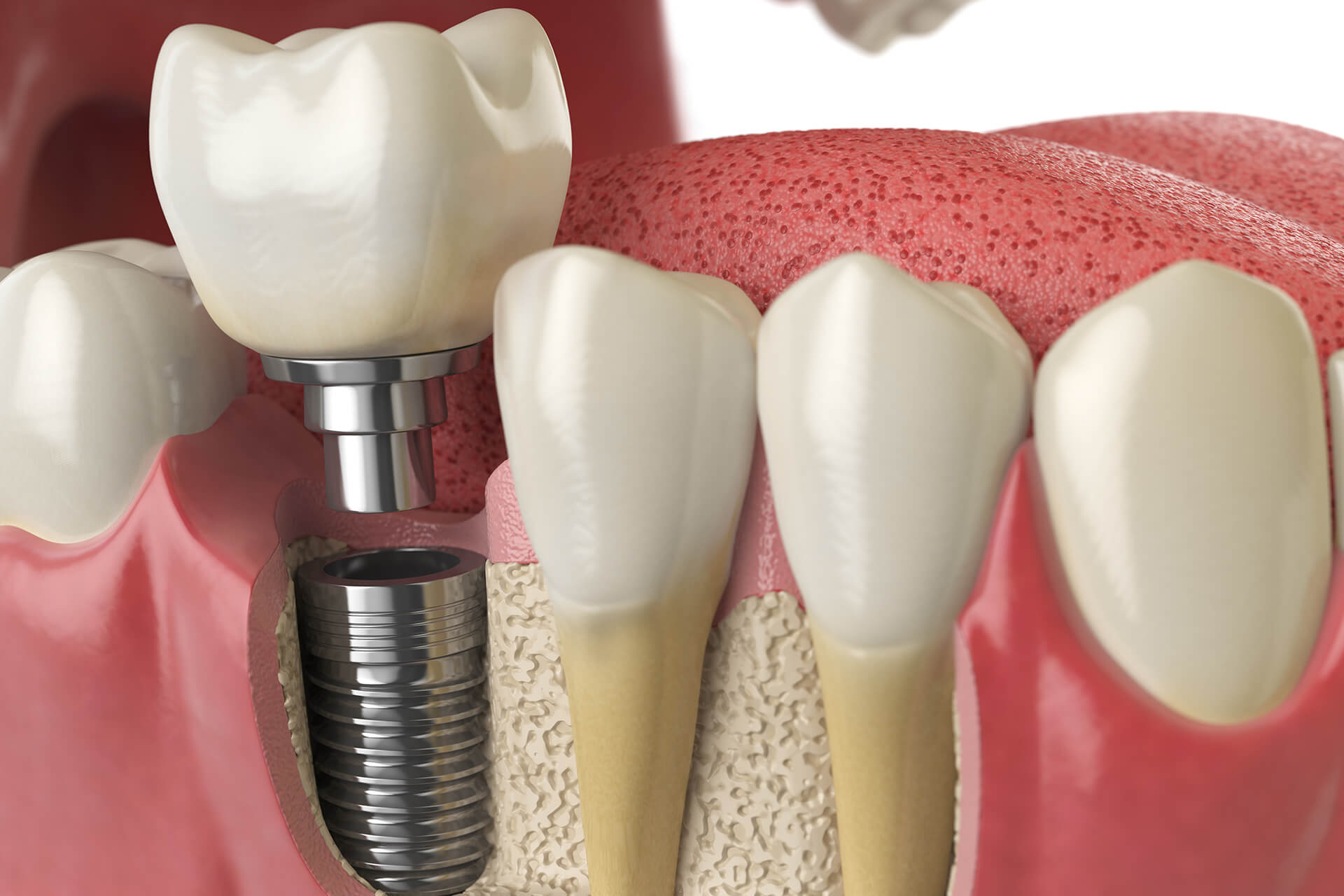 Implantes Dentales